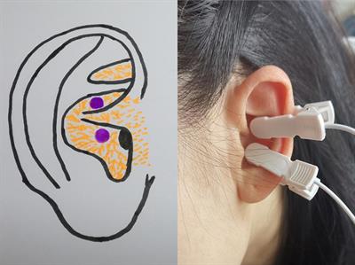 Brain Functional Mechanisms Determining the Efficacy of Transcutaneous Auricular Vagus Nerve Stimulation in Primary Insomnia